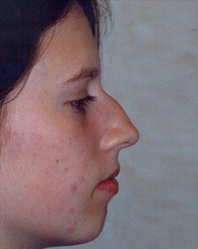 Rhinoplasty-03 | Before Face