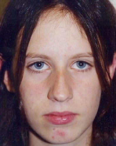 Rhinoplasty-03 | Before Rhinoplasty 2
