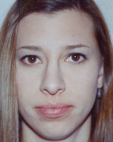 Rhinoplasty-04 | After Rhinoplasty 2