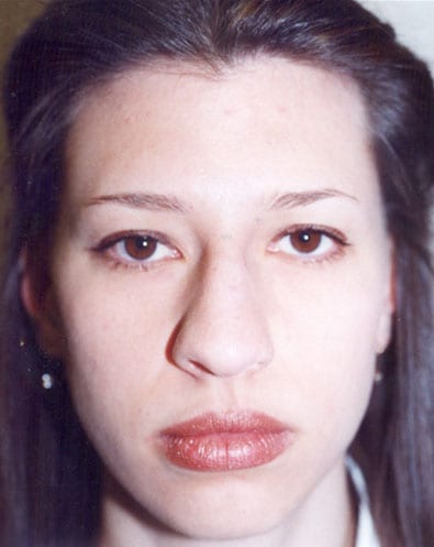 Rhinoplasty-04 | Before Rhinoplasty 2