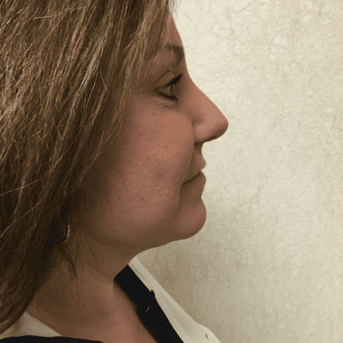 post op facelift neck lift