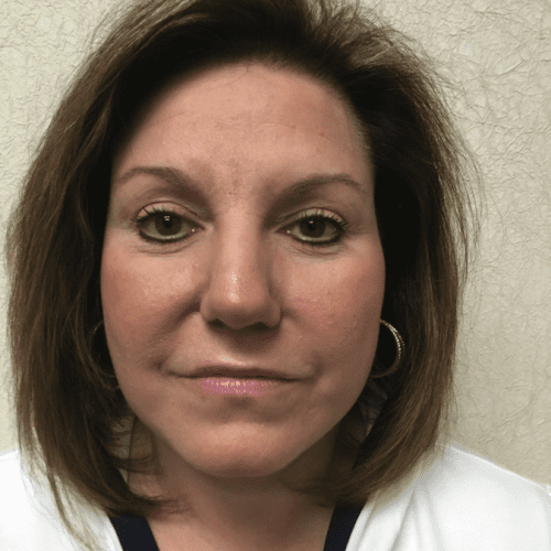 post op facelift neck lift