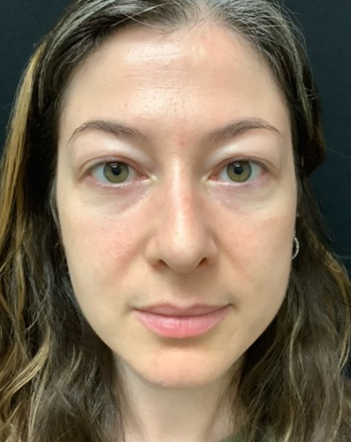 Rhinoplasty-07 | After Rhinoplasty 2