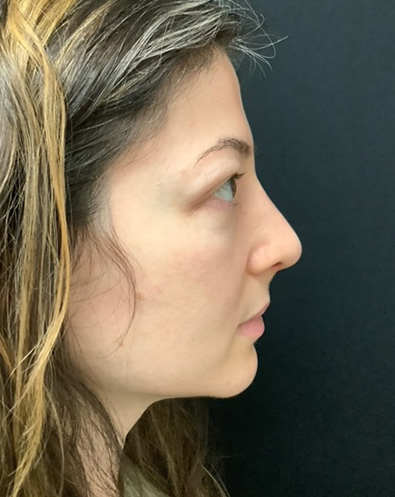 post op rhinoplasty
