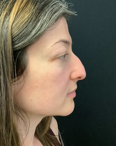 pre op rhinoplasty