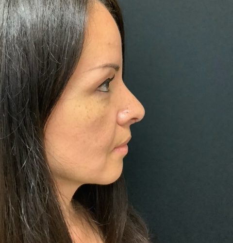 post op rhinoplasty