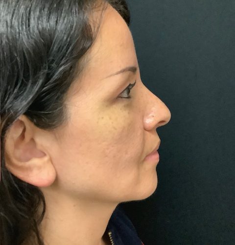 pre op rhinoplasty