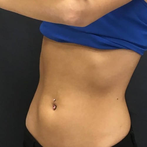 After SculpSure