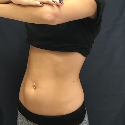 before SculpSure