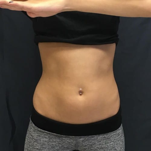 before SculpSure