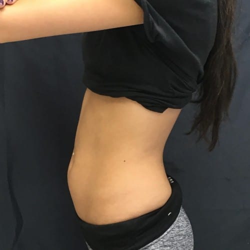 before SculpSure