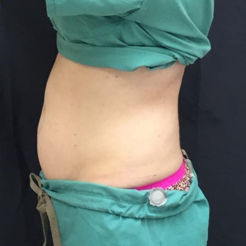 Sculpsure-02 | After Sculpsure