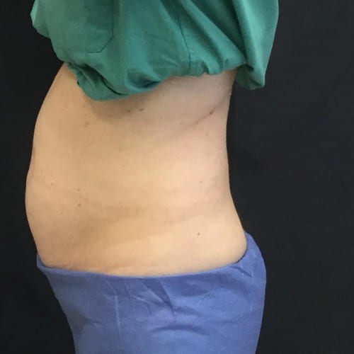 Sculpsure-02 | Before Sculpsure