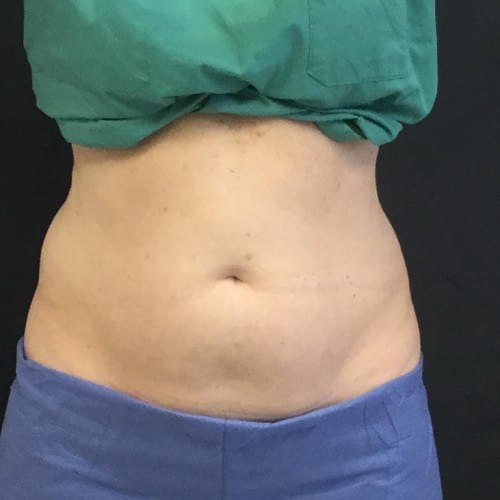 Sculpsure-02 | Before Sculpsure 2