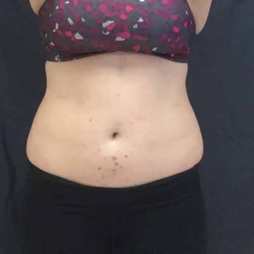 Sculpsure-03 | After Sculpsure 2